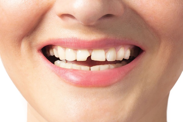 How A Dentist Can Repair A Broken Tooth And Restore Your Smile