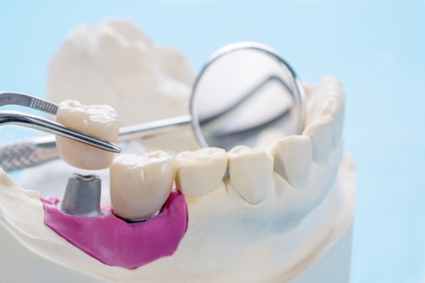 The Number Of Dental Visits For A Dental Crown