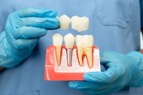 Discover The Lifelong Benefits Of A Dental Implant For Your Oral Health