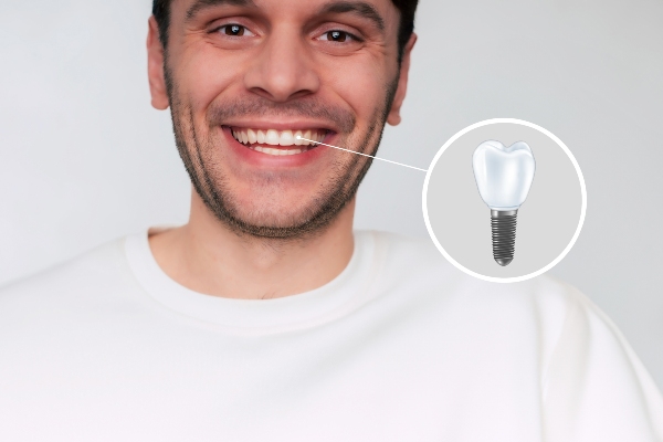 Dental Implants Vs Other Tooth Replacement Options