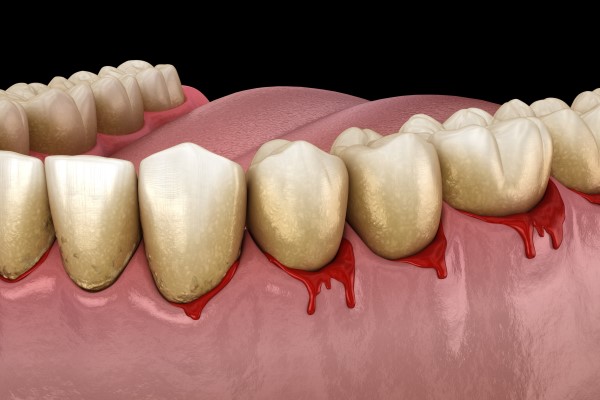 The Most Common Types Of Gum Disease